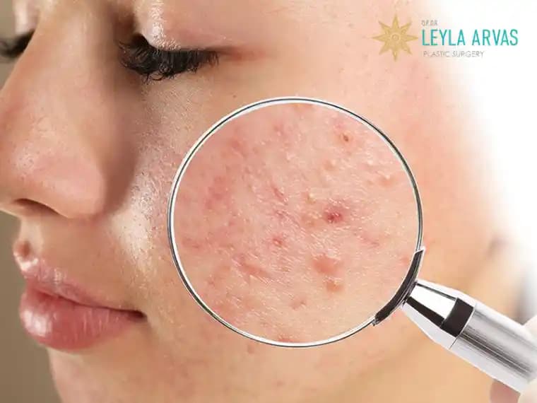 Sivilce İzleriyle Mücadele ve Doğal Çözümler İçin Etkili Yöntemler Rehberi