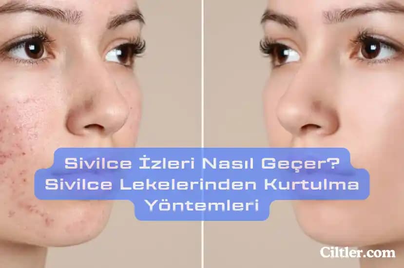 Sivilce İzleriyle Mücadelede Güncel ve Etkili Yöntemler ve Cilt Bakım İpuçları