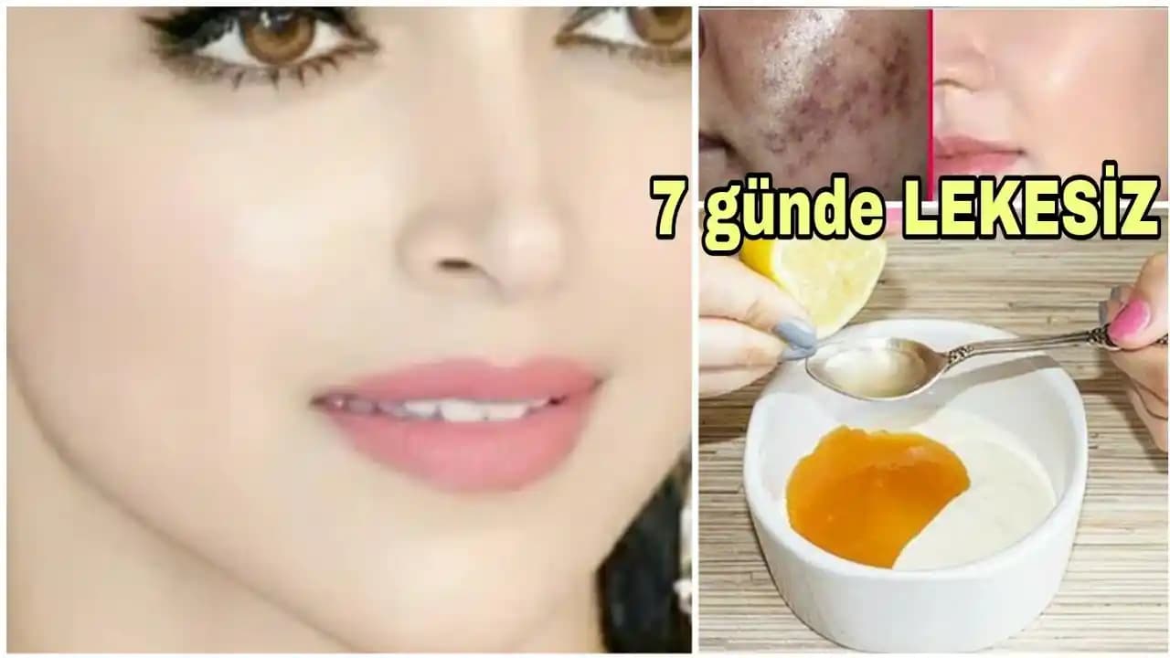 Sivilce Lekeleri ve Etkili Cilt Bakım Yöntemleri Uzman Tavsiyeleriyle