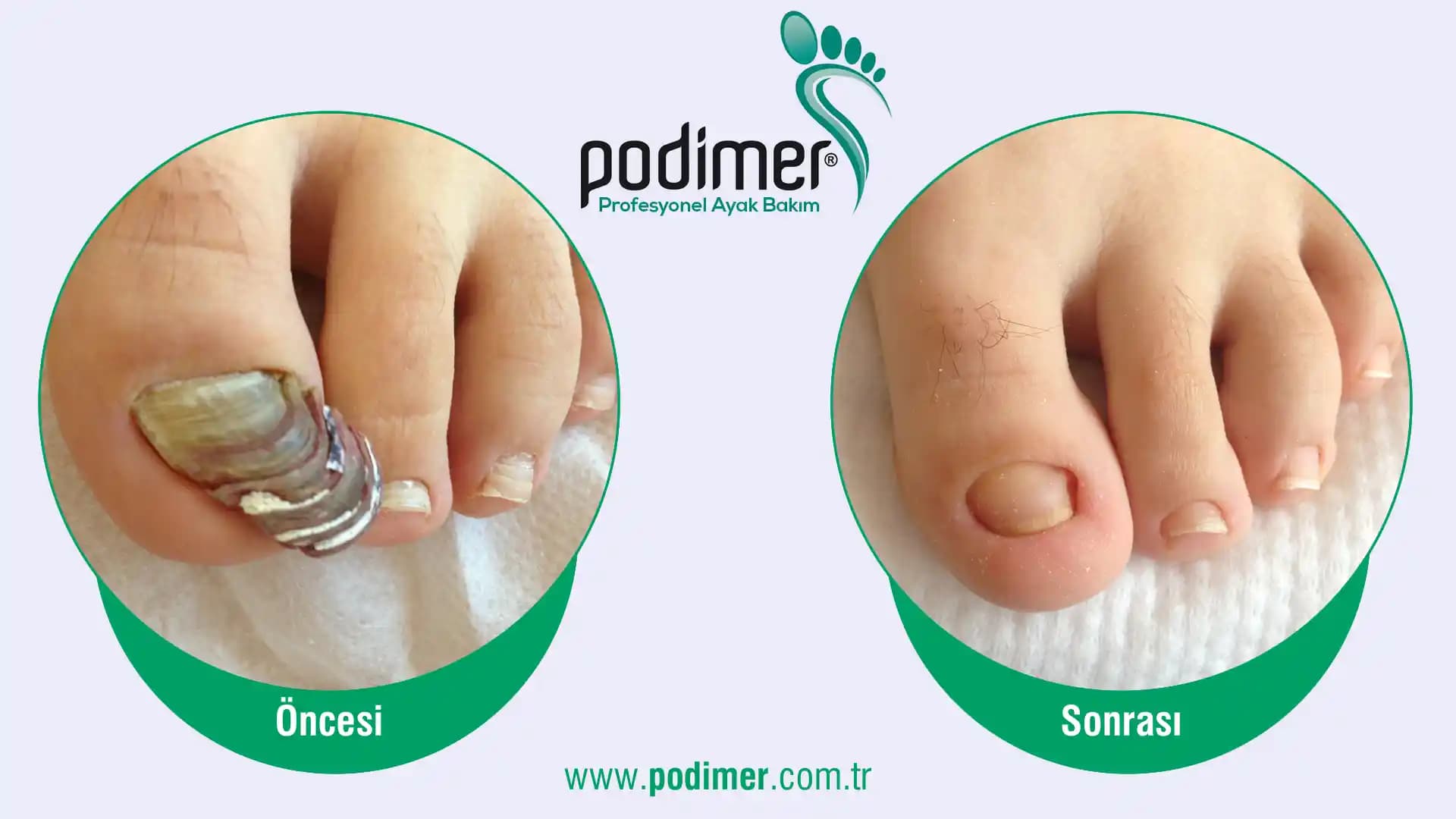 Tırnak Mantarı İçin En Etkili Ürünler ve Tedavi Yöntemleri Hakkında Güncel Bilgiler