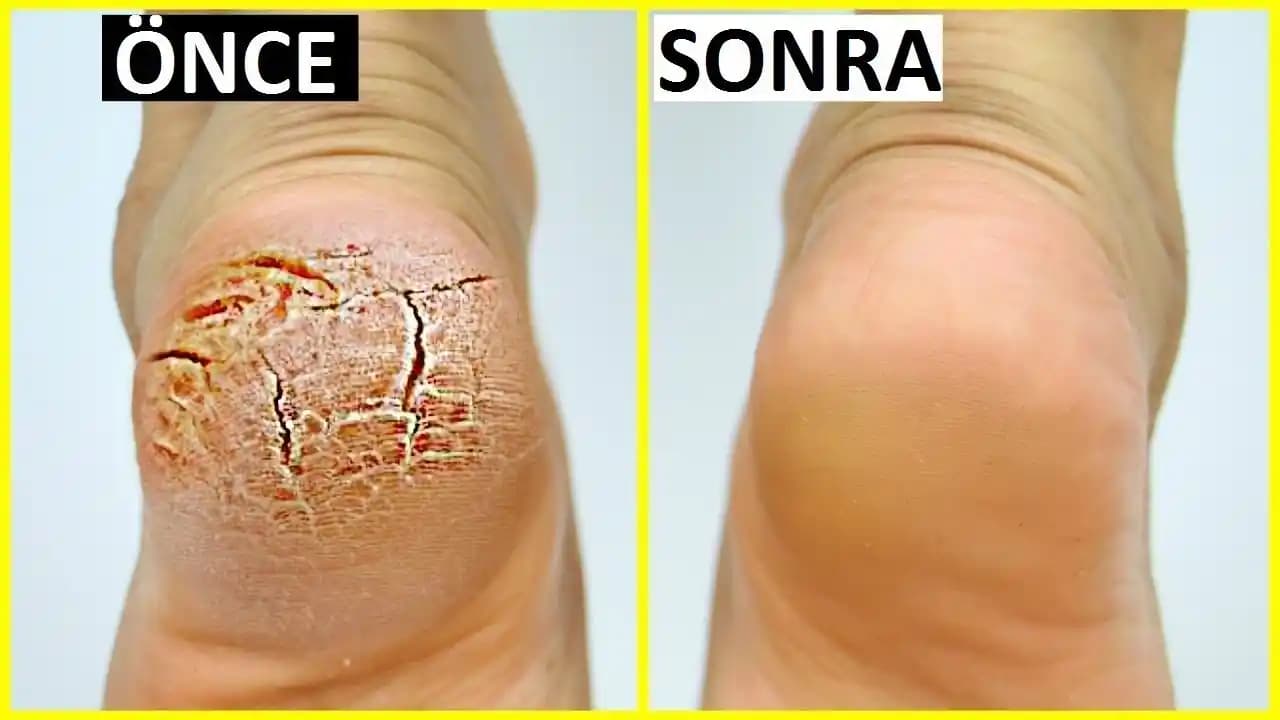 Topuk Çatlağı Nedenleri ve Etkili Tedavi Yöntemleri Hakkında Kapsamlı Bilgi