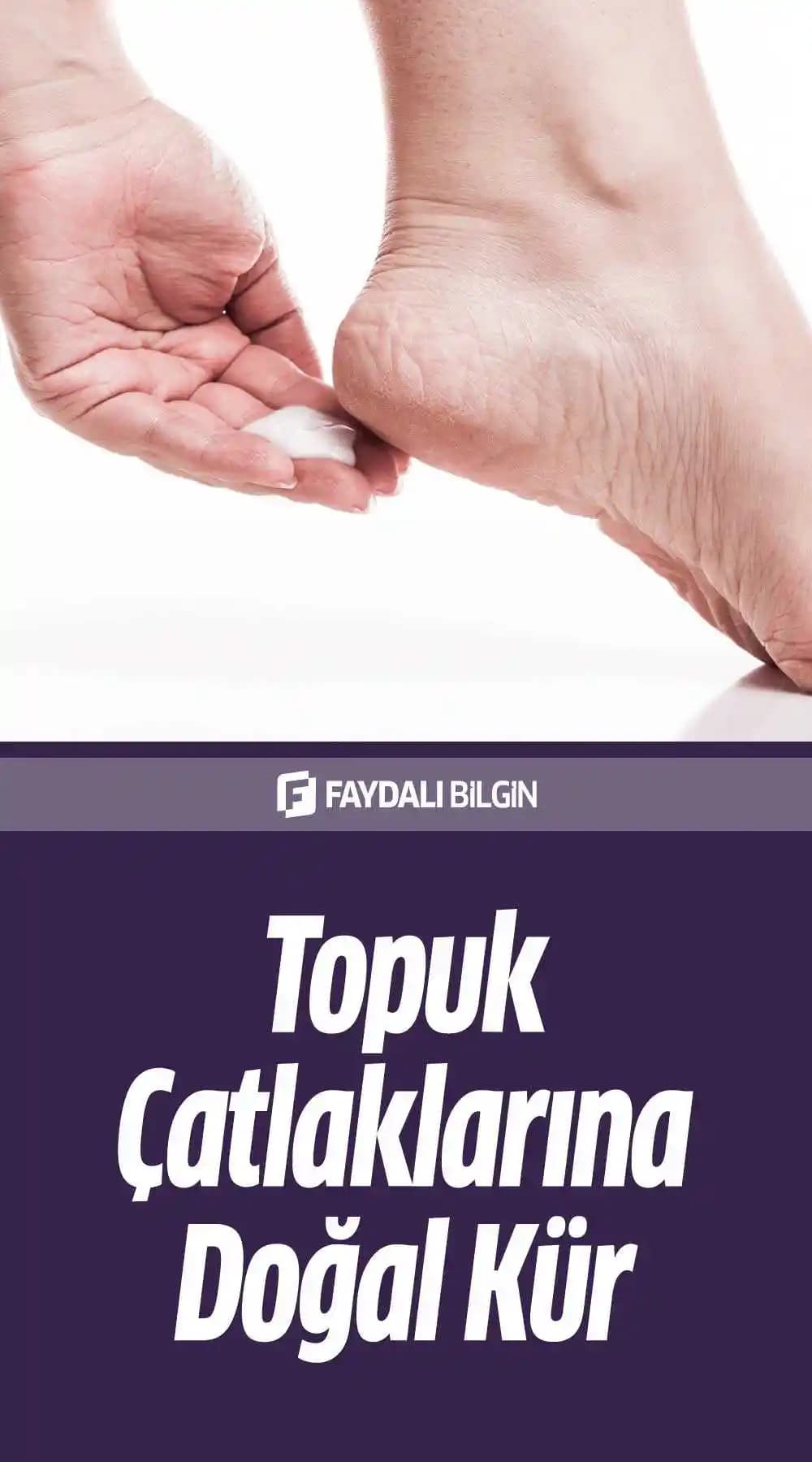 Topuk Çatlaklarına Karşı Doğal ve Etkili Çözüm Yöntemleri