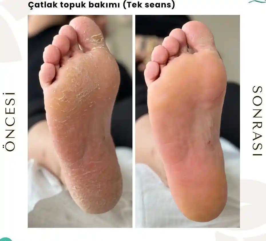 Topuk Çatlaklarının Nedenleri ve Koruma Yöntemleri: Etkili Bakım İpuçları