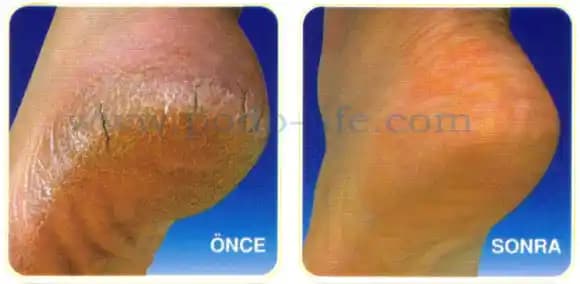 Topuk Çatlamasının Nedenleri ve Korunma Yöntemleri Hakkında Detaylı Bilgi