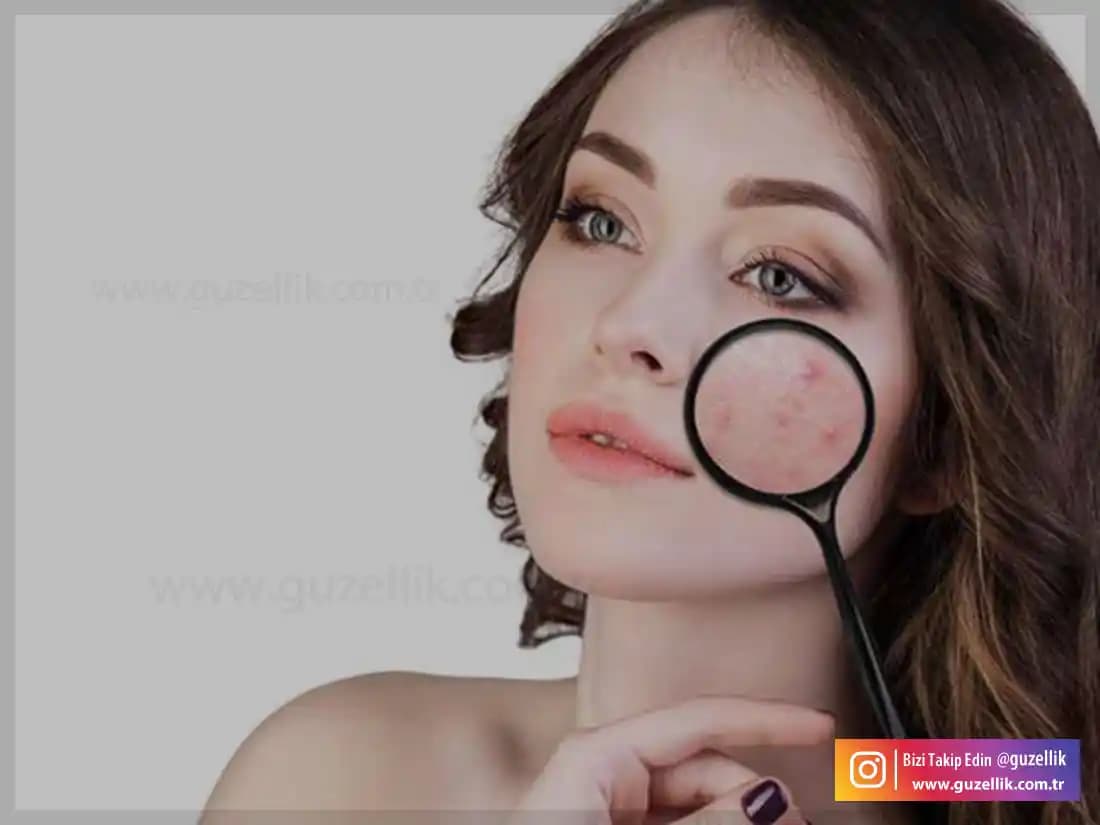 Uzun Süreli Sivilceler İçin Etkili Bakım Yöntemleri ve Tedavi Seçenekleri