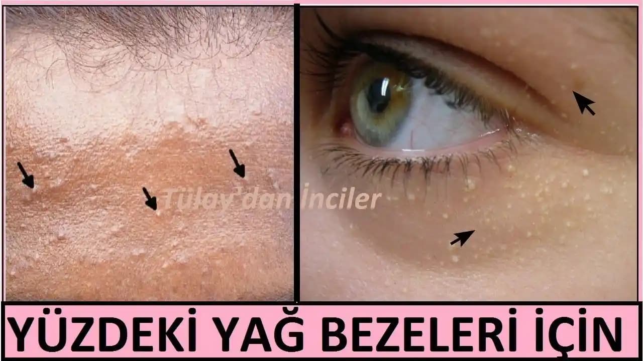 Yağ Bezeleri ve Cilt Sağlığında Güncel Kozmetik Yaklaşımlar