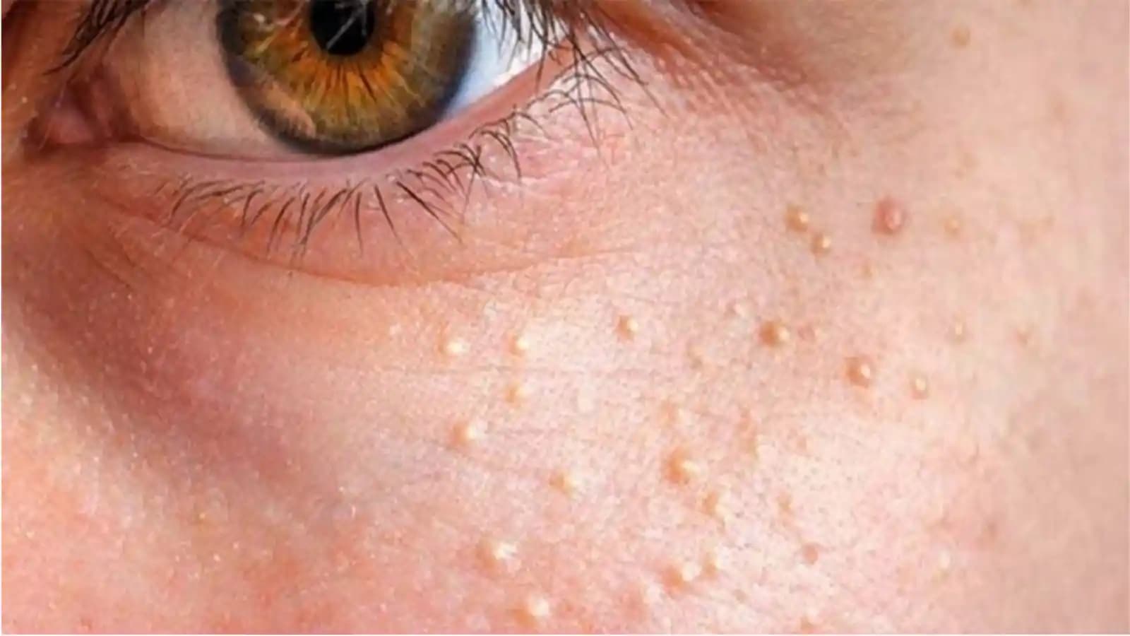 Yüzde Yağ Bezeleri Nedenleri Belirtileri ve Etkili Önleme Yöntemleri