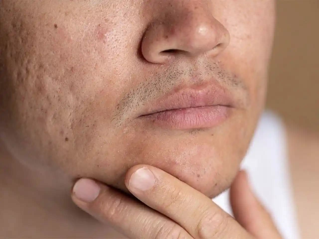 Yüzde Yağ Bezeleri Nedir, Nasıl Tanınır ve Etkili Tedavi Yöntemleri Nelerdir