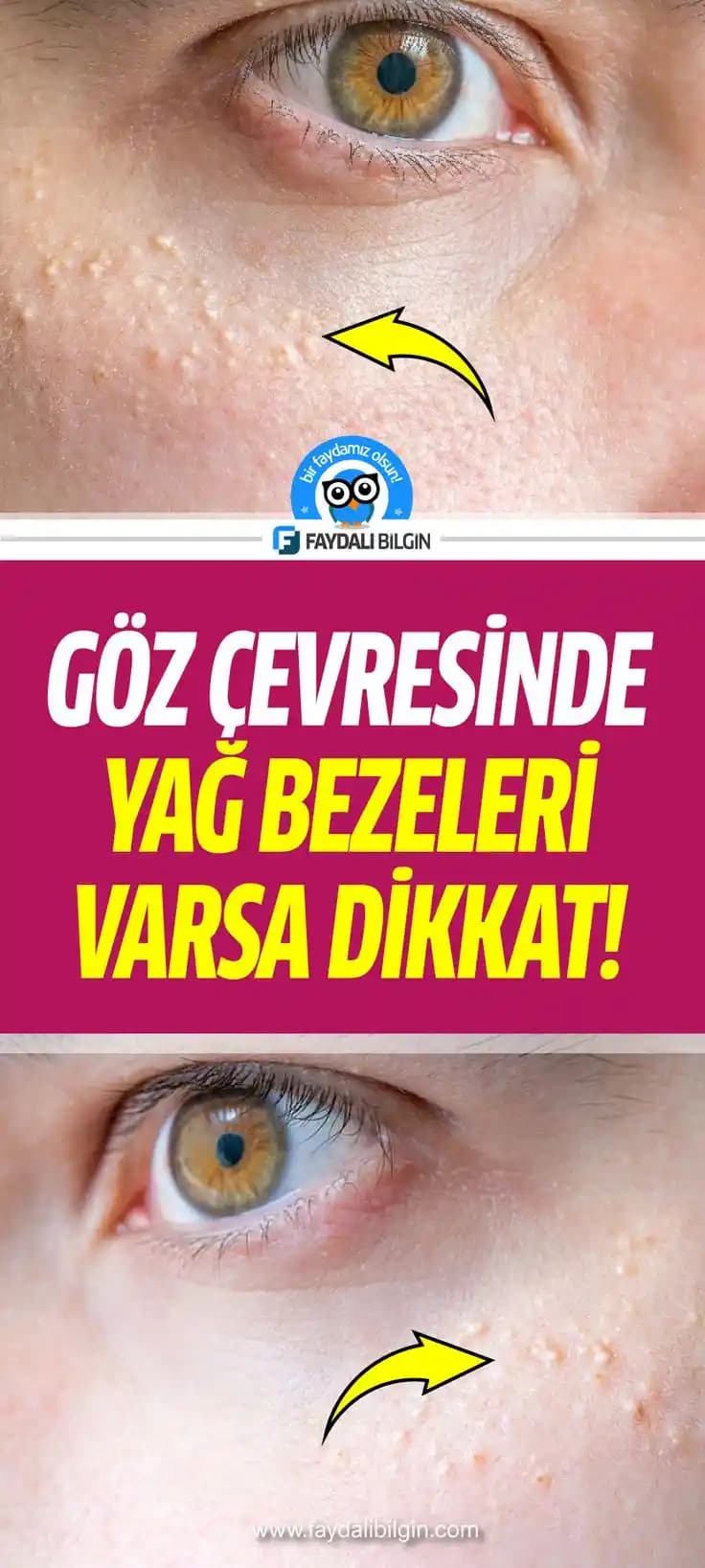 Yüzdeki Yağ Bezeleriyle Mücadele ve Bakım Yöntemleri: Nedenleri ve Etkili Çözümler