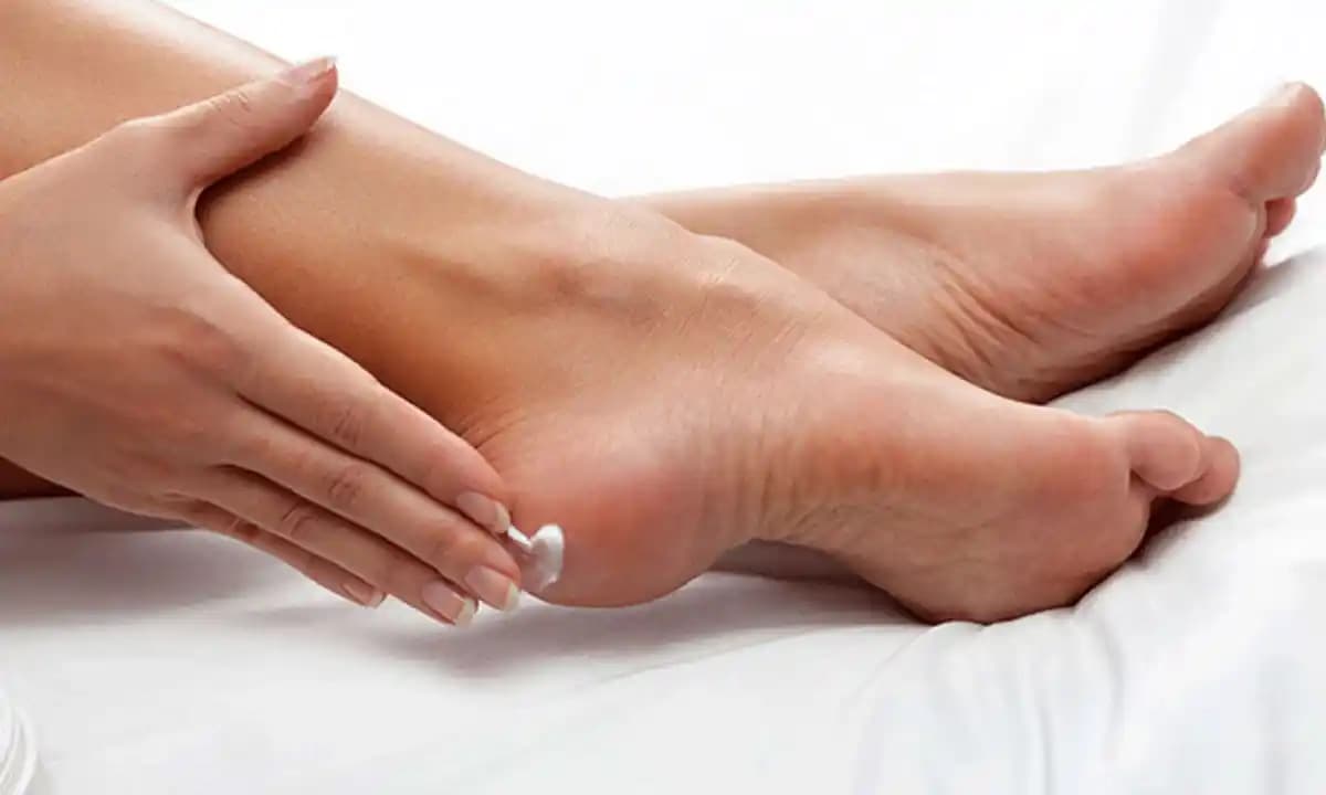 Topuk Çatlağına Karşı Etkili Yöntemler ve Bakım İpuçları