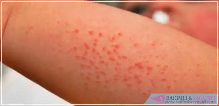 Yetişkinlerde Pişik Tedavisi ve Önleme Yöntemleri Hakkında Detaylı Bilgi