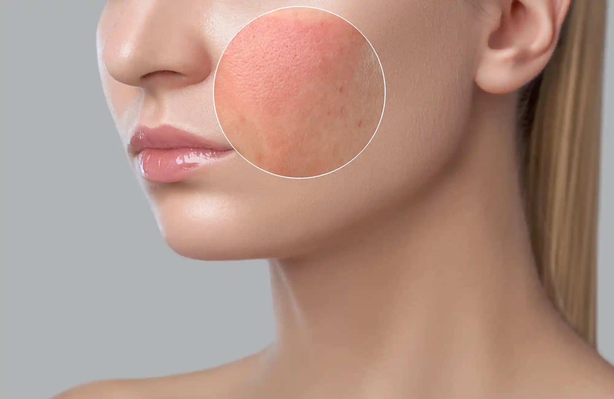 Yüzde Kızarıklık ve Kozmetik Alerjilerinin Nedenleri ve Korunma Yöntemleri