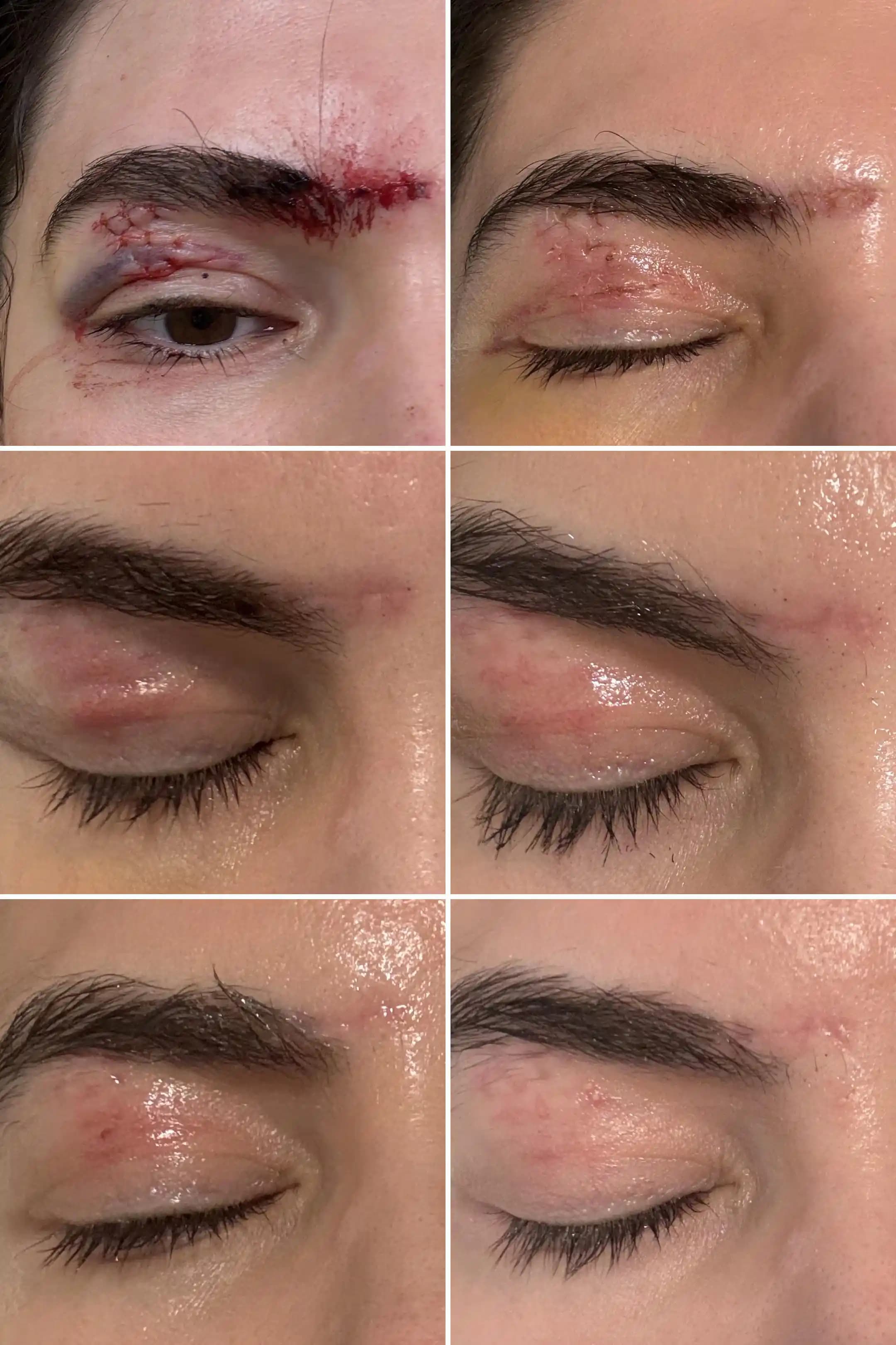 30 Günlük Yara İyileşme Süreci ve İzlerin Azaltılması İçin Uygulanan Yöntemler