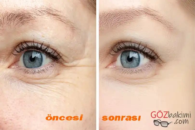 30'lu Yaşlarda Göz Altı İnce Çizgileri İçin Bakım ve Etkili Tedavi Yöntemleri