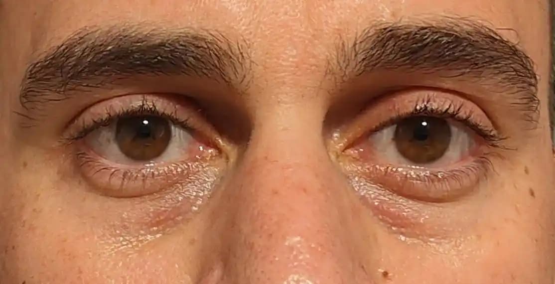 37 Yaş ve Üzeri Erkeklerde Göz Altı Çöküklükleri: Nedenleri ve Tedavi Yöntemleri