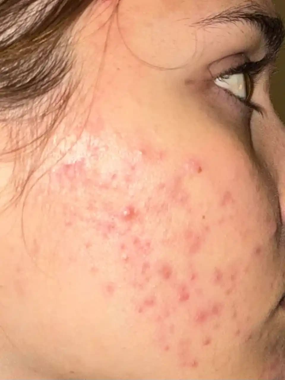 Accutane Kullanımı, Yan Etkileri ve Alternatif Akne Tedavi Yöntemleri 22 Yaş Kadınlar İçin