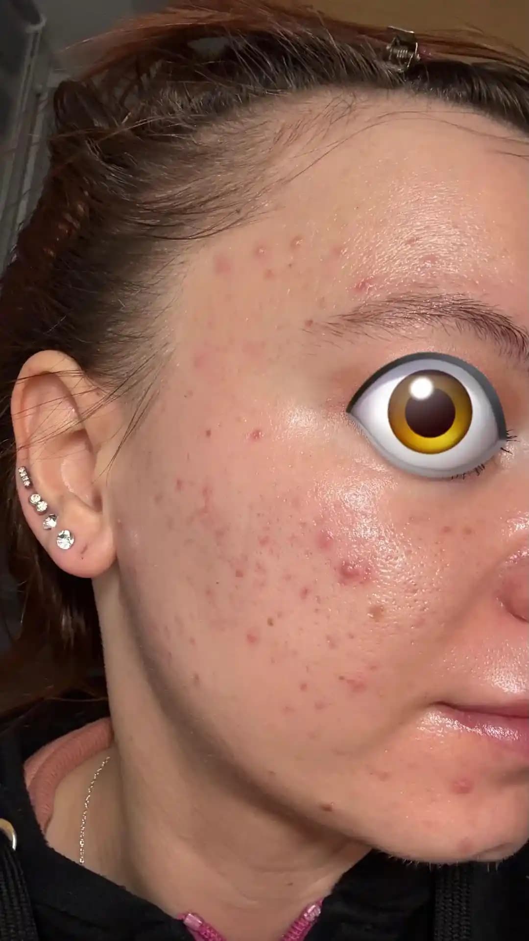 Akne Tedavisinde Accutane Öncesi Alternatif Yöntemler ve Etkili Uygulamalar