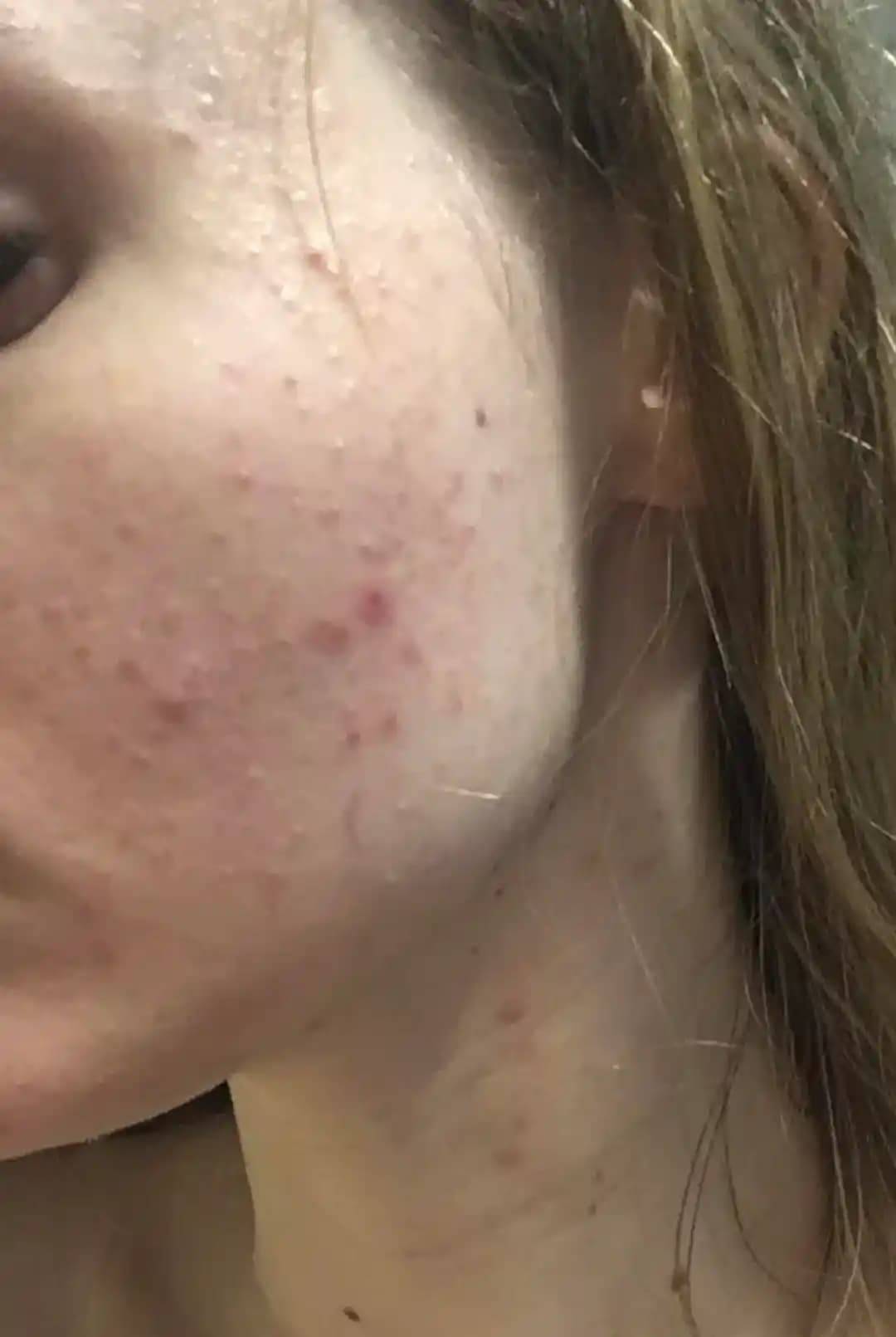 Akne Tedavisinde Doğum Kontrolü ve Kapsamlı Cilt Bakım Rutinlerinin Önemi ve Uygulamaları