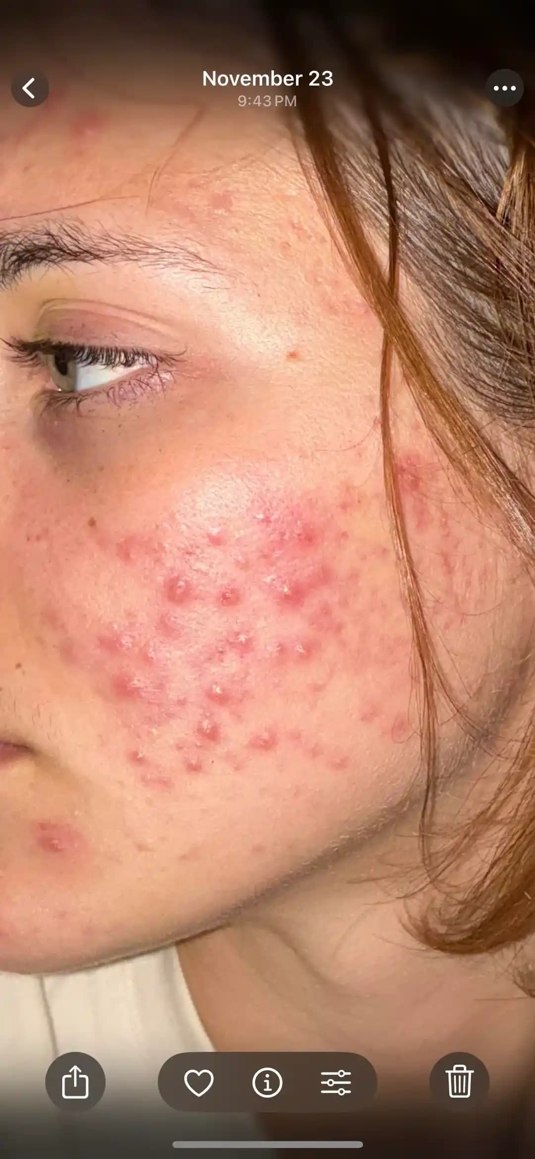 Akne Tedavisinde İyileşme Süreci ve Holistik Yaklaşımların Önemi