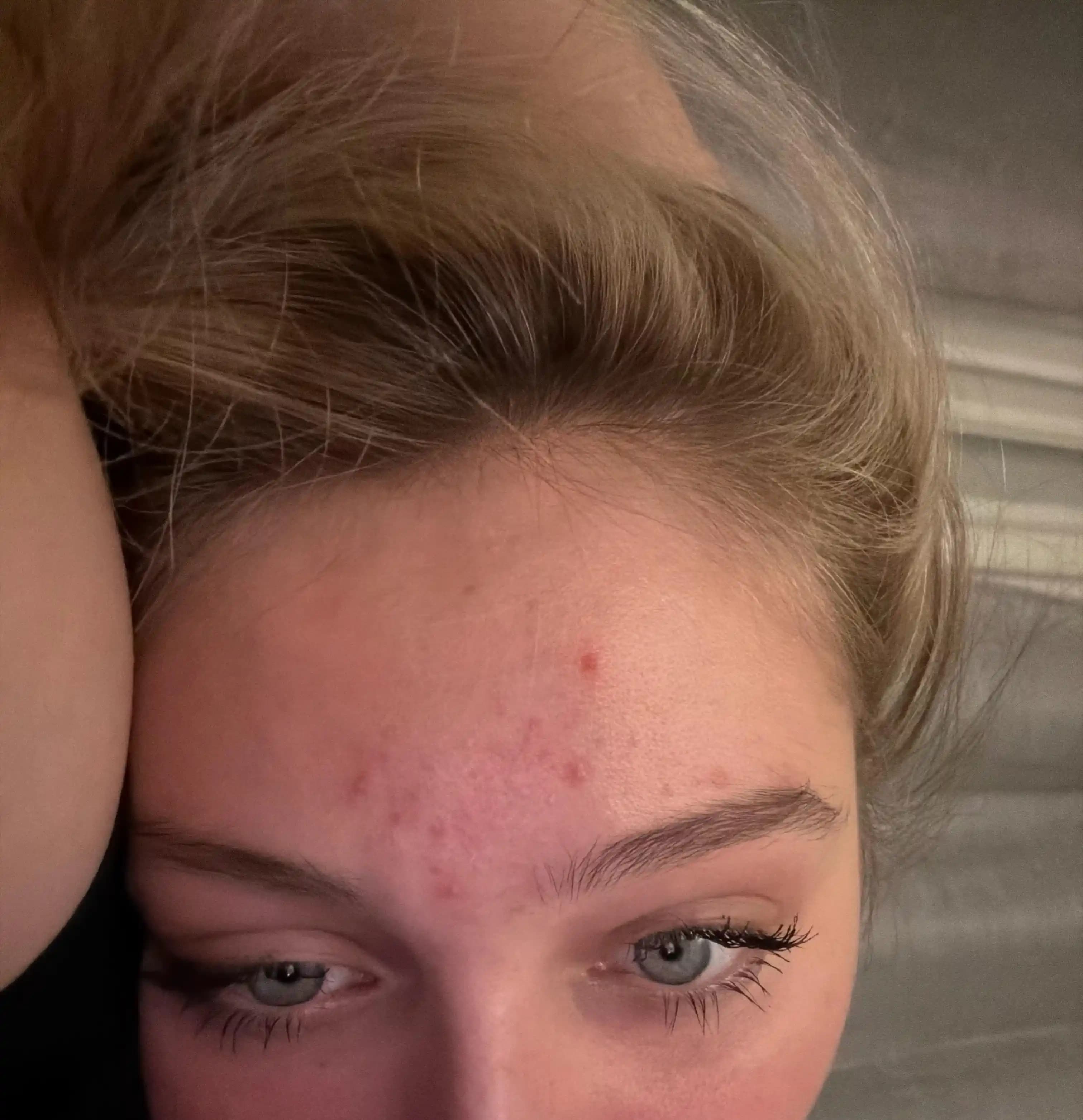 Alın Bölgesindeki Akne Sorununun Yönetimi ve Etkili Tedavi Yöntemleri