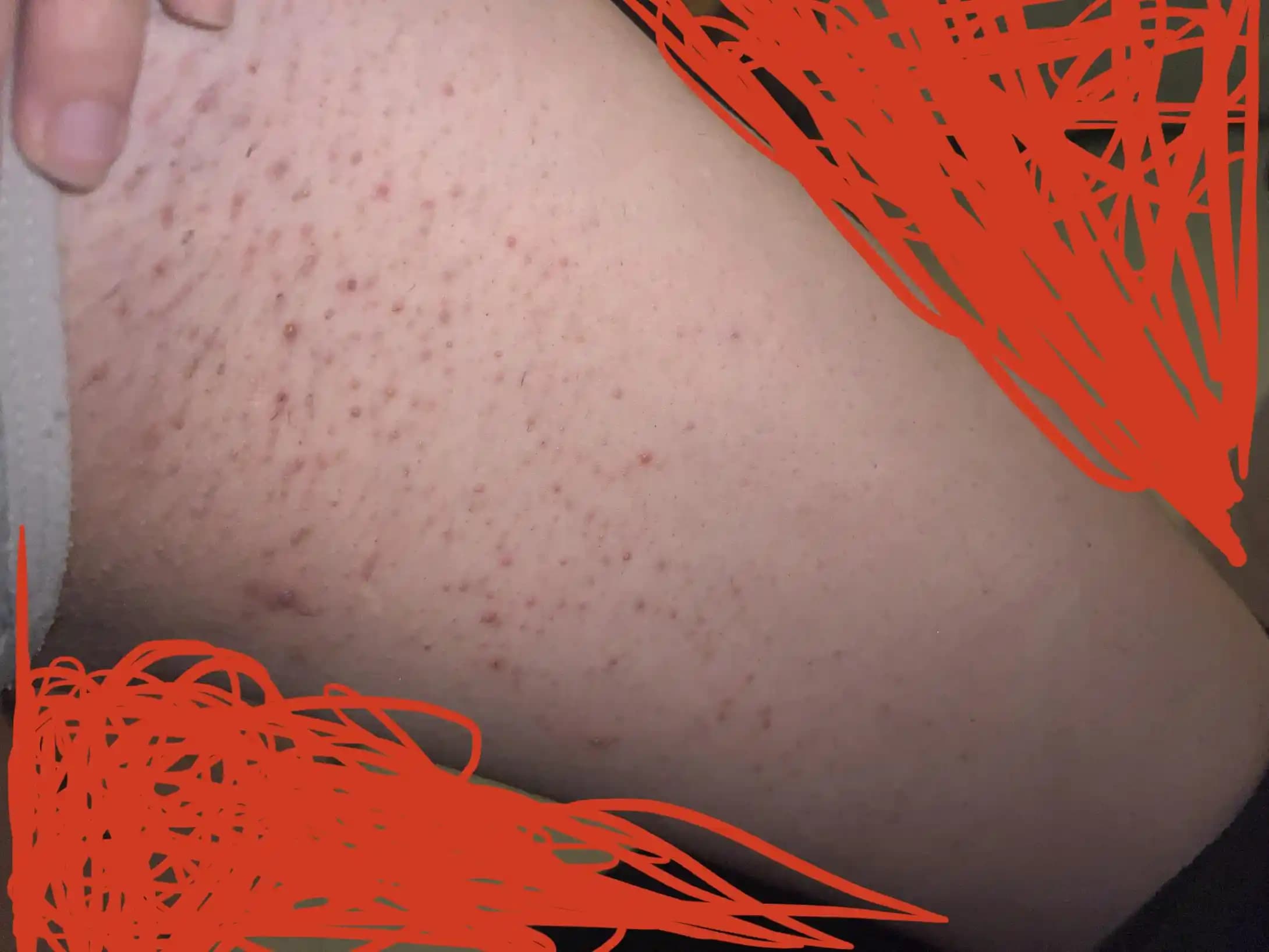 Bikini Bölgesi Tüy Dökümü Sonrası Cilt Sorunları ve Etkili Bakım Yöntemleri