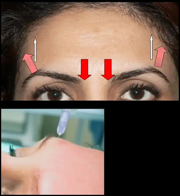 Botoks Sonrası Kaş Üstü Şişlikleri: Nedenleri, Süreci ve Çözüm Yolları