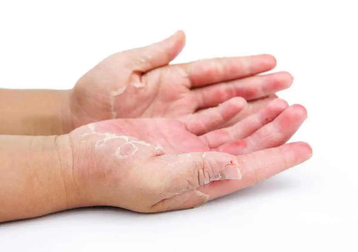 Çene Bölgesinde Sürekli Kızarıklık Nedenleri ve Etkili Tedavi Yöntemleri