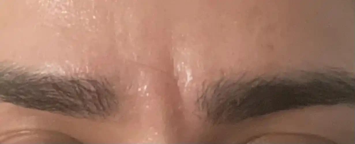 Derin Kırışıklıklar İçin Non-invaziv Yöntemler ve Etkinliklerinin Kapsamlı İncelemesi