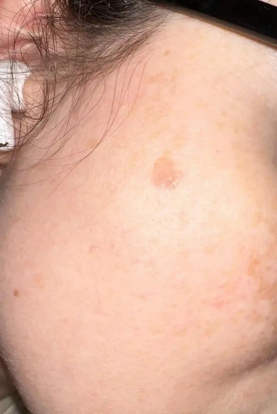 Doğum Sonrası Yüz Lekelerinin Nedenleri, Özellikleri ve Dermatolojik Önemi