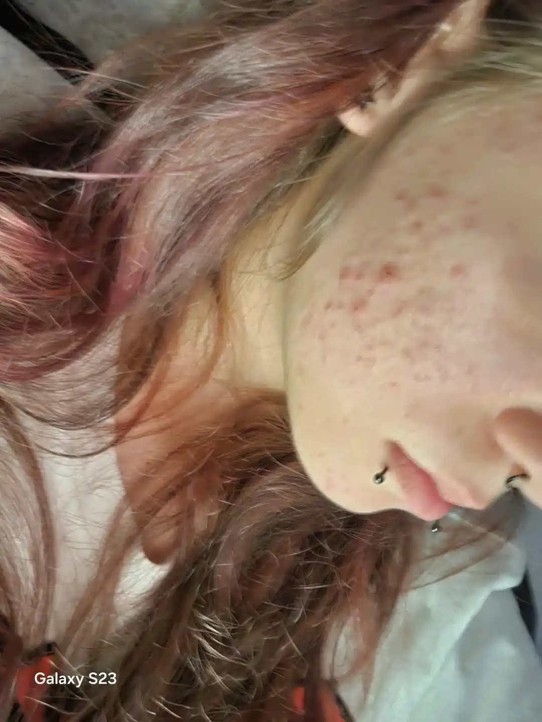 Epiduo Kullanımı ve Akne Tedavisinde Etkili Topikal İlaç Rehberi