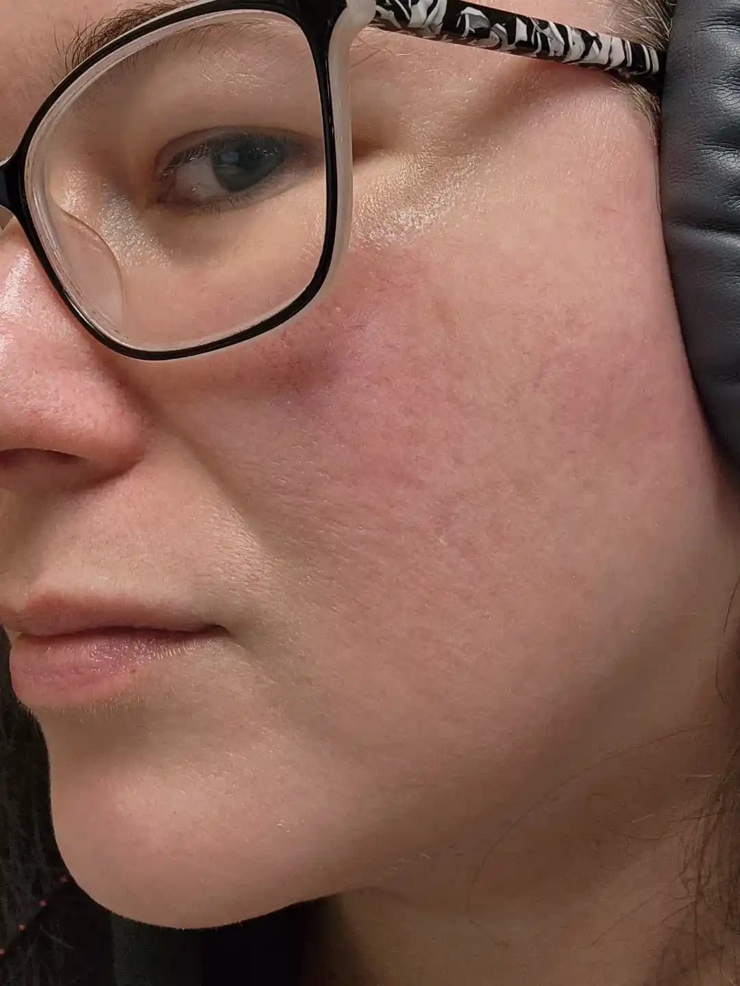 Eski Akne İzlerinde Kızarıklık ve Cilt Düzensizliklerini Azaltma Yöntemleri ve Tedavi Seçenekleri