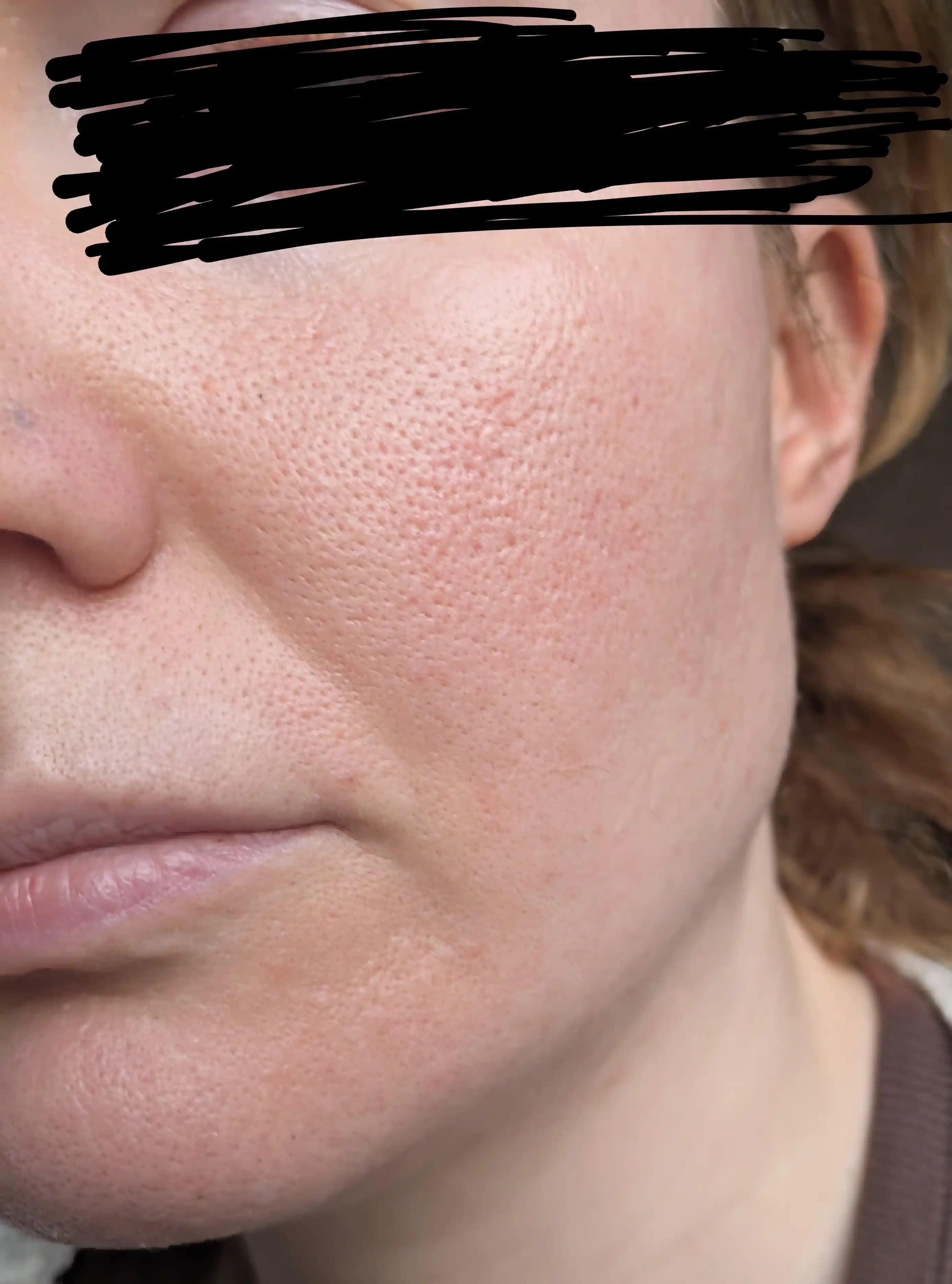 Geniş Gözenekler ve Cilt İzleri İçin Etkili Tedavi Yöntemleri ve Bakım Önerileri