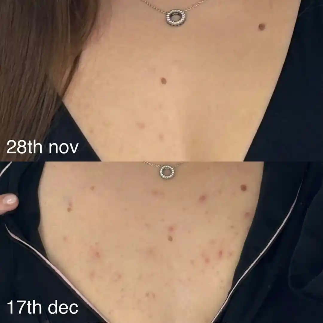 Göğüs ve Sırtta Aniden Ortaya Çıkan Aknenin Nedenleri ve Etkili Tedavi Yöntemleri