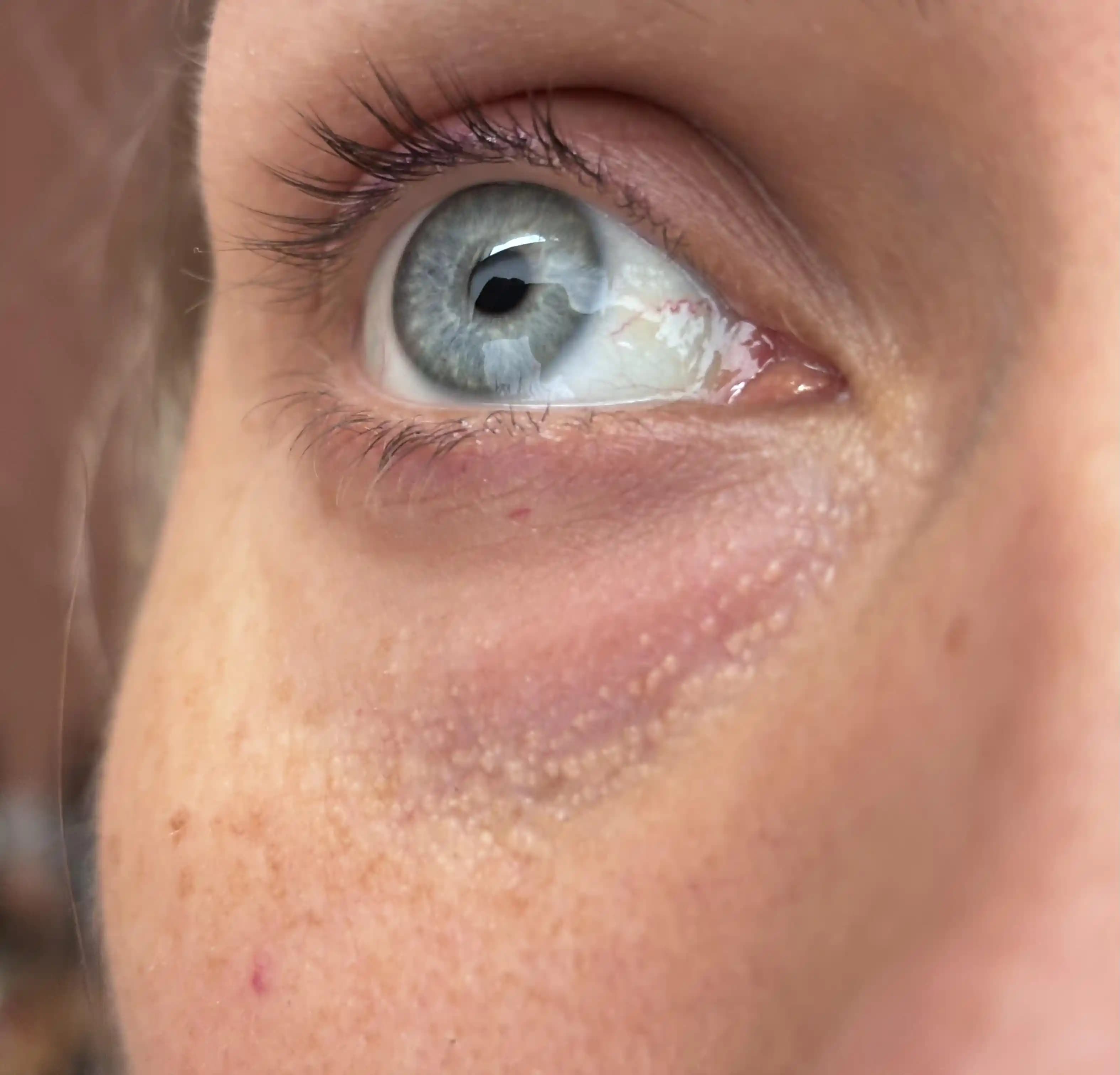 Göz Altı Morlukları: Nedenleri, Tedavi Yöntemleri ve Etkili Makyaj Teknikleri