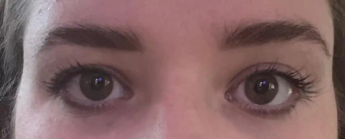 Göz Kapaklarındaki Asimetri: Estetik Yaklaşımlar ve Psikolojik Etkiler