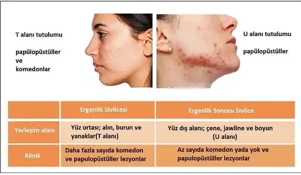Günlük 20-30 Yeni Beyaz Nokta: Akne ve Fungal Akne Tedavi Yöntemleri ve Farkları