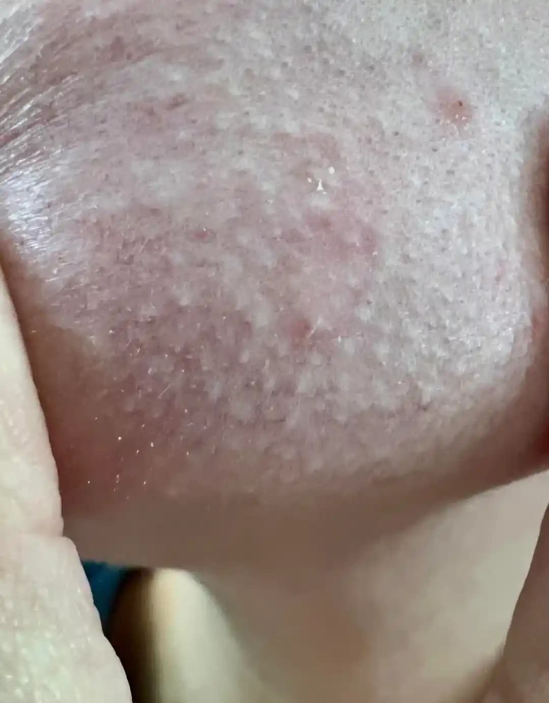 Hamilelik Sonrası Cilt Problemleri ve Etkili Bakım Yöntemleri