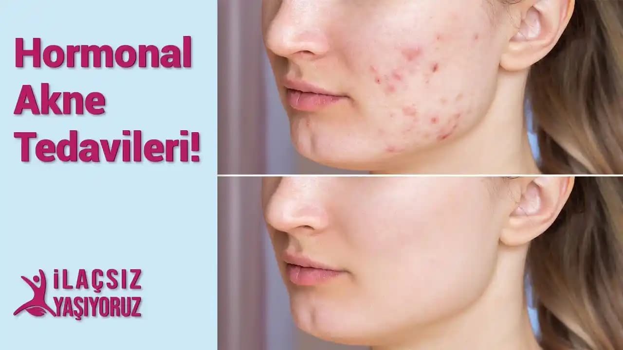 Hormonal Akne Tedavisinde Etkili Yöntemler, Cilt Bakımı ve Yaşam Tarzı Önerileri