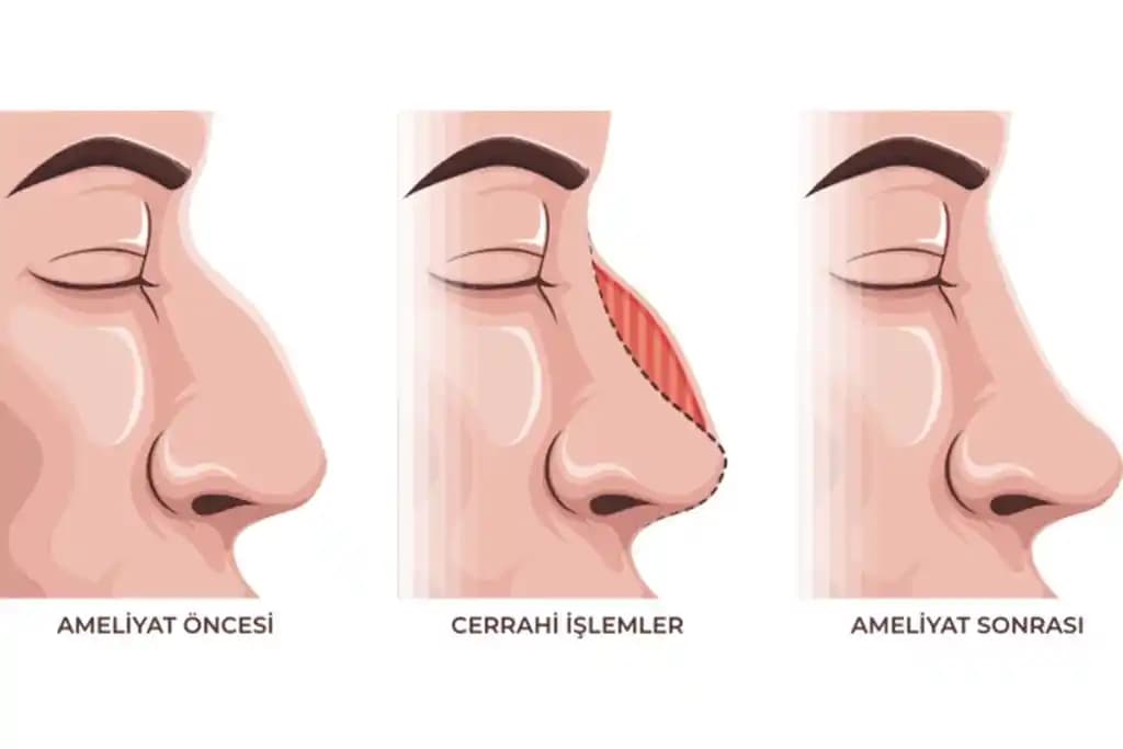 Ilso Burun Bandı ile Sebase Filamentlerin Azaltılması: İki Aşamalı Temizleme Yöntemi