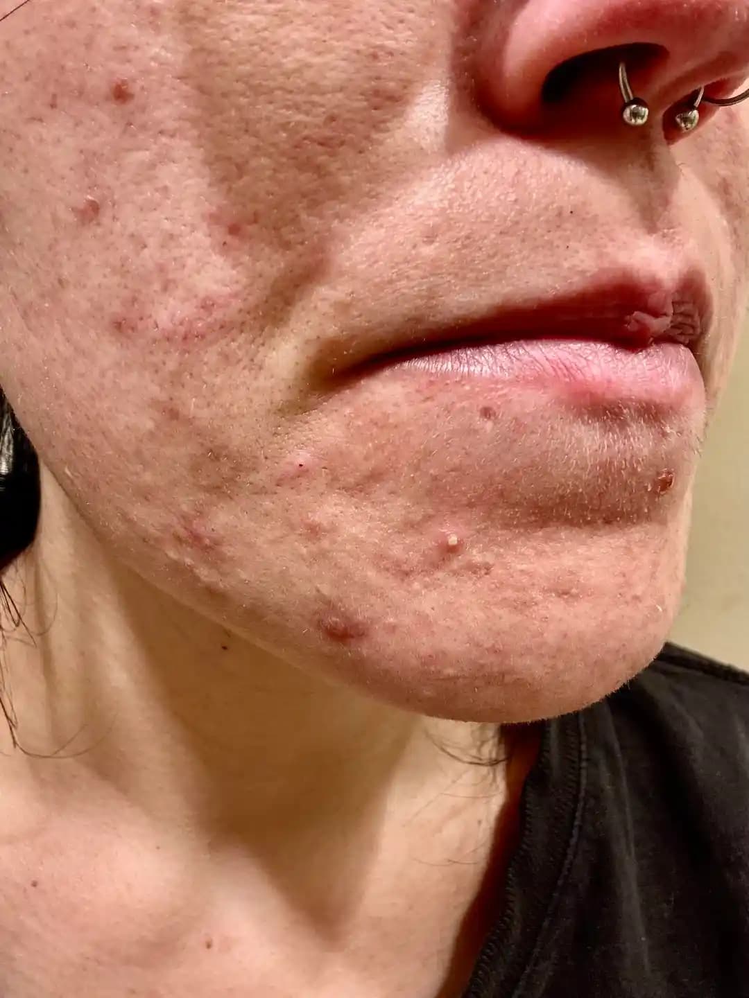 Kapalı Komedonlar, Tıkalı Gözenekler ve Akne İçin Etkili Cilt Bakım Rehberi