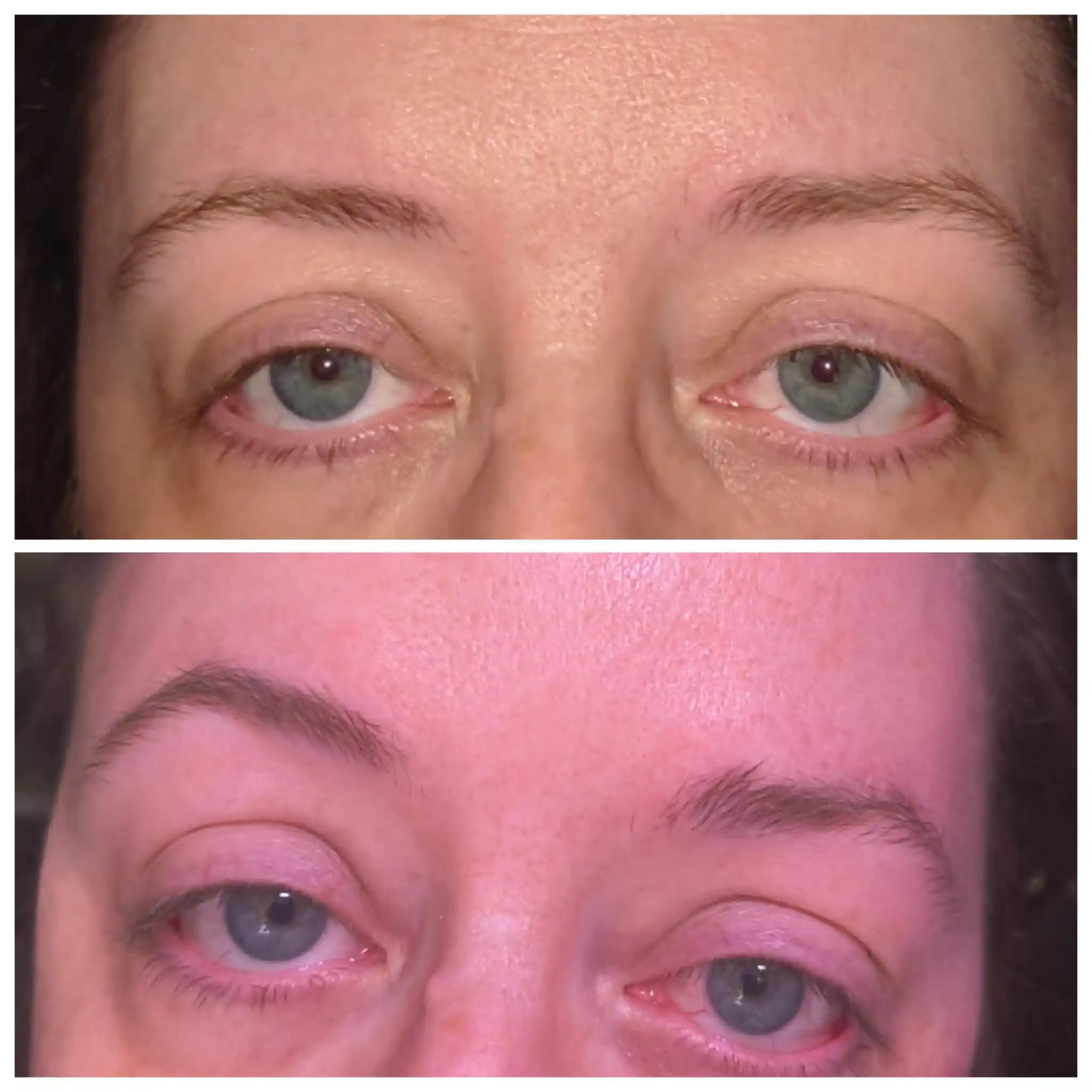 Kaşlarda Minoksidil Kullanımı: Etkiler, Uygulama Yöntemleri ve Yan Etkiler Hakkında Bilgi