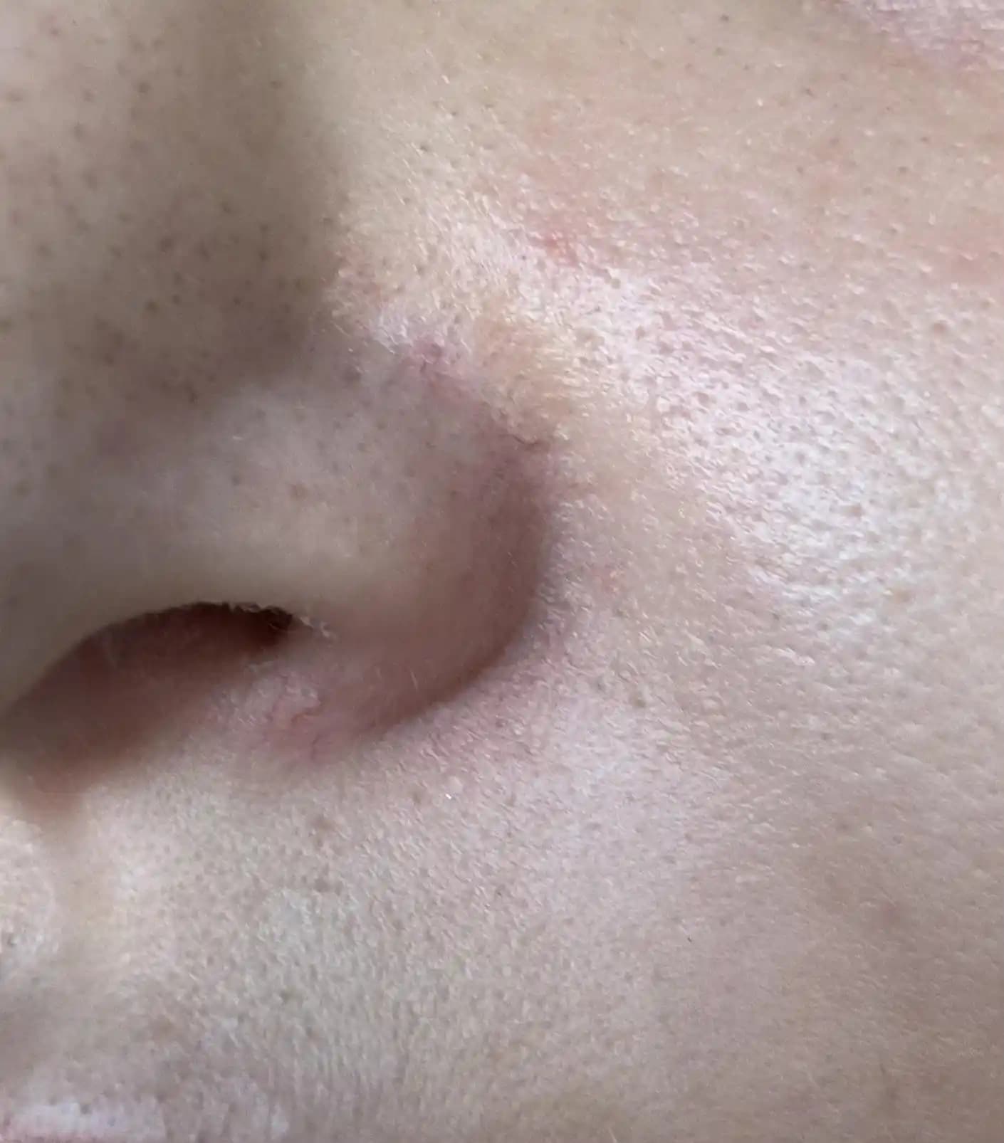 Kırık Kılcal Damarların Tedavisinde Lazer ve Işık Terapilerinin Etkinliği ve Yöntemleri