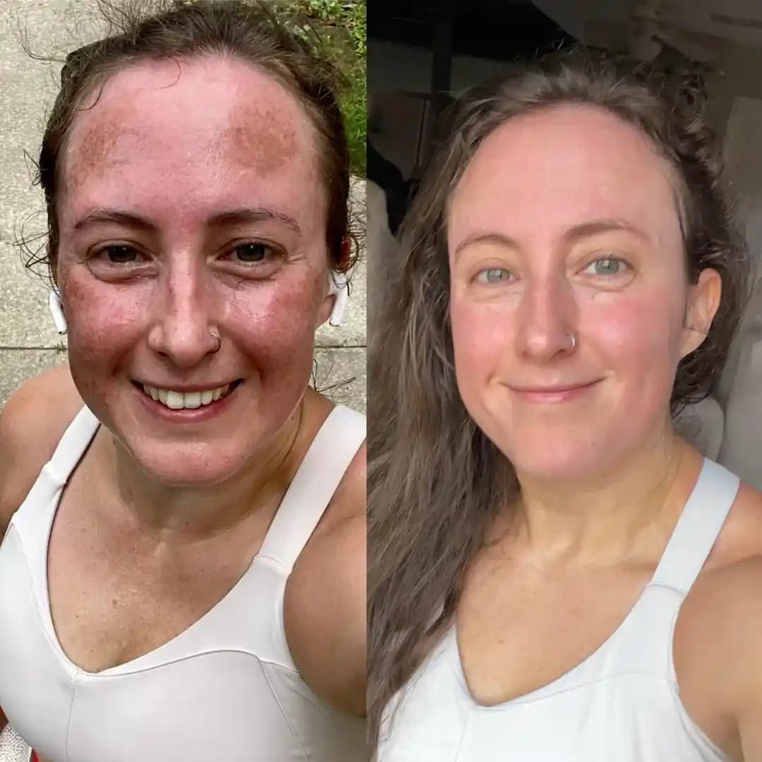 Melazma Yönetiminde Güneş Koruyucu Kullanımının Cilt Sağlığına Etkileri ve Tedavi Yöntemleri