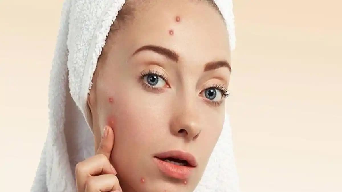 Mikroiğneli Sivilce Bantları: İşleyişi, Kullanımı ve Popüler Marka İncelemeleri