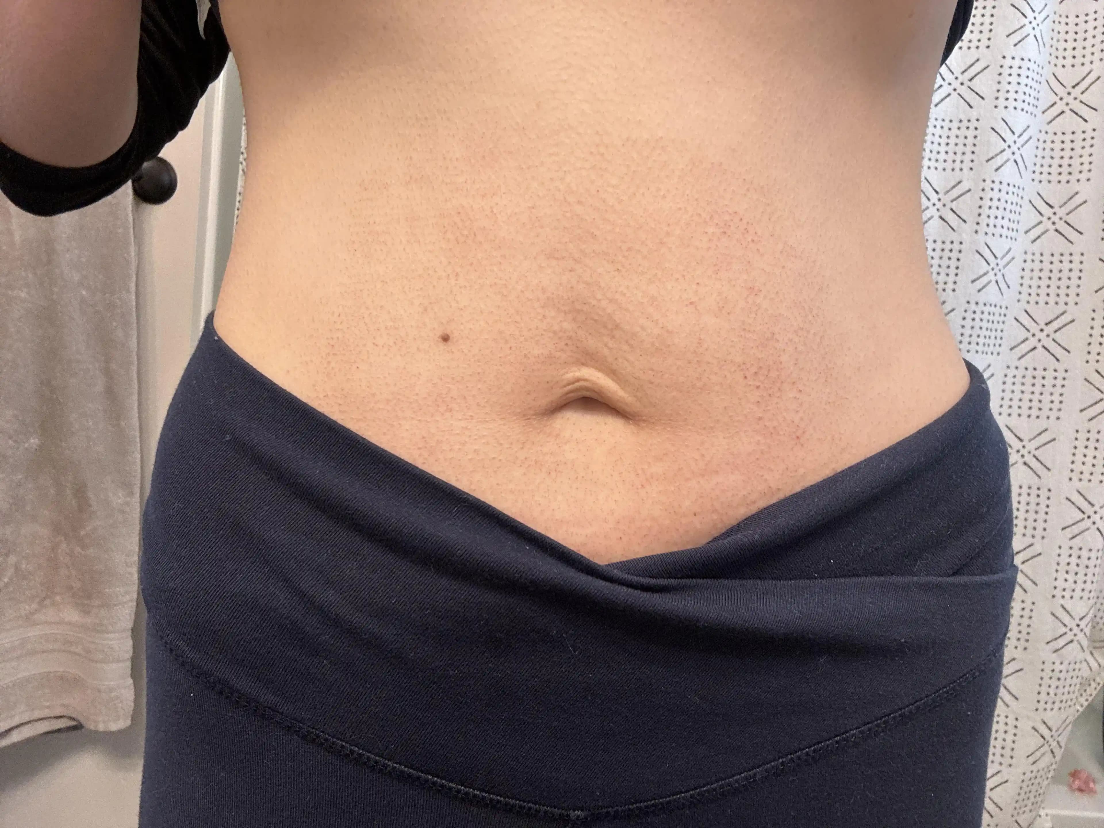 Morpheus8 Tedavisi ile Gebelik ve Kilo Kaybı Sonrası Gevşek Karın Derisi Sıkılaştırma