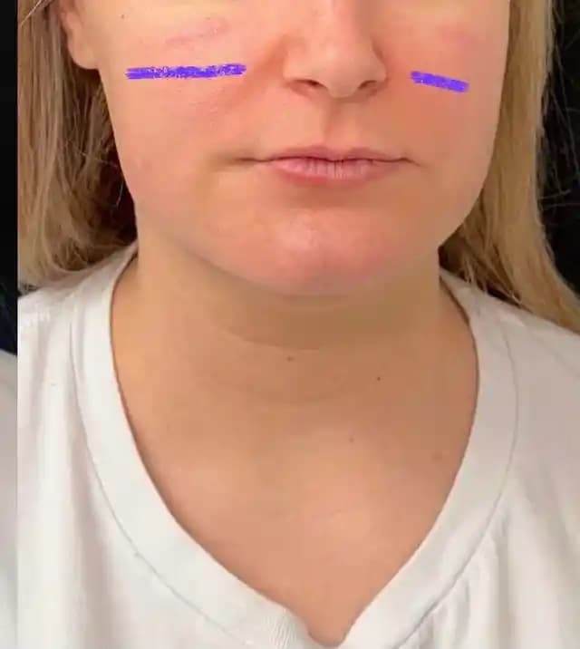 Orta Yüz Dolgusu Sonrası Şişlik ve Kabarıklık: Süreç, Nedenler ve Bakım Önerileri