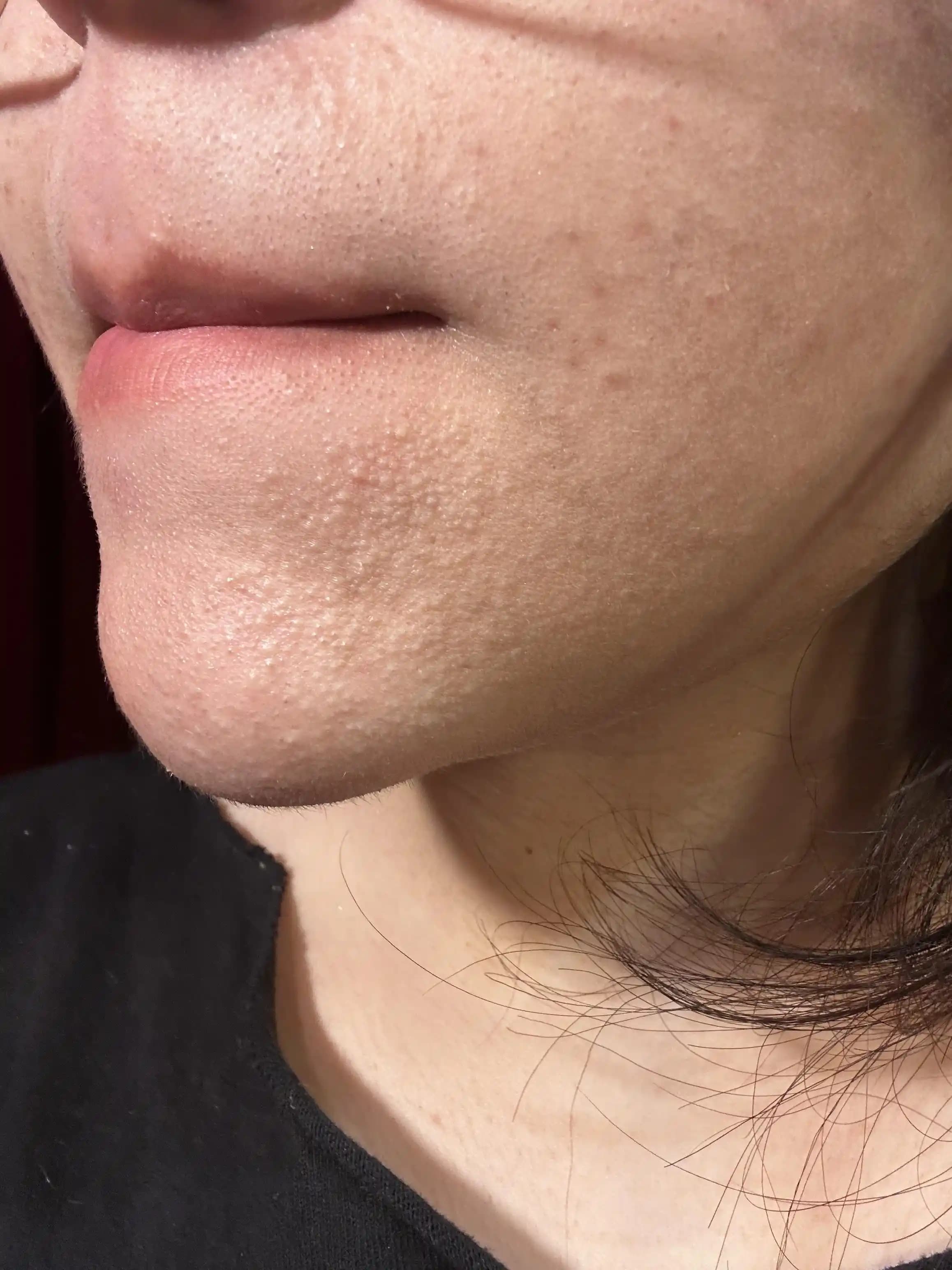 Tıkalı Gözeneklerin Yönetimi ve Cilt Bakımında Etkili Yaklaşımlar