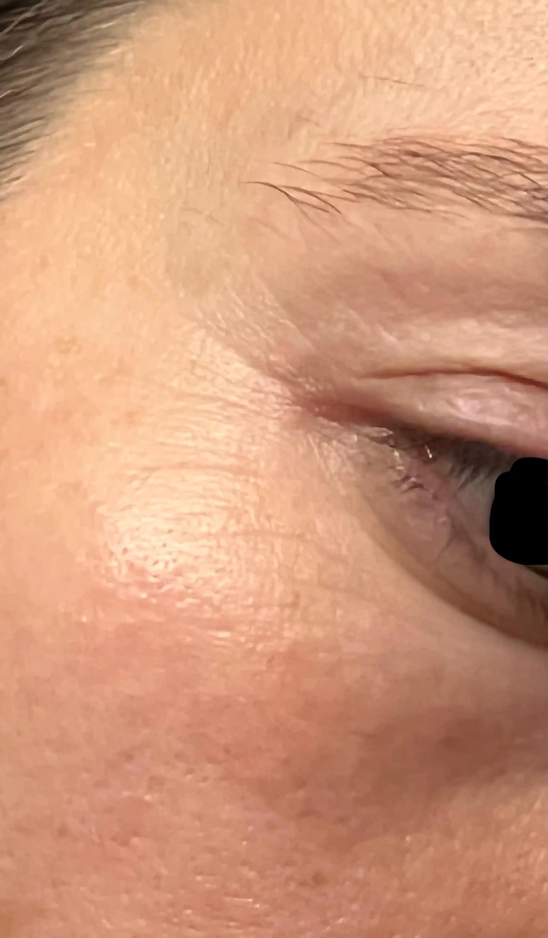 Tüp Bebek (IVF) Sonrası Göz Çevresi Kırışıklıkları: Nedenleri ve Etkili Bakım Yöntemleri