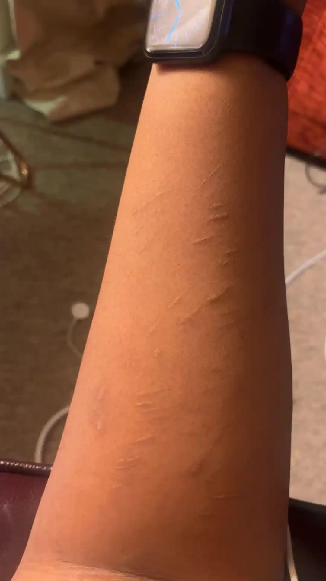 Yara İzlerinin Solma Süreci ve Görünümünü Azaltma Yöntemleri Hakkında Bilgi