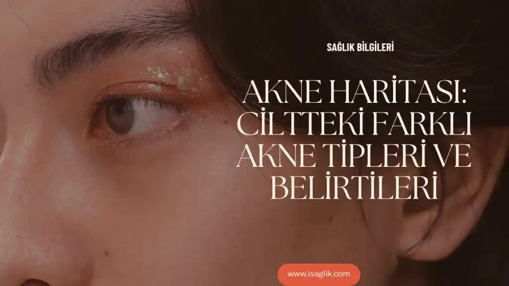 Yıllarca Dirençli Akne Tedavisinde Medikal ve Yaşam Tarzı Yaklaşımları